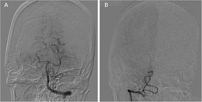 The prevalence and clinical significance of intracranial vertebral artery terminated in posterior inferior cerebellar artery: A multicenter hospital-based study in China